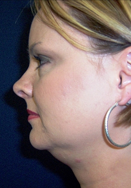 Vaser Liposelection Before & After