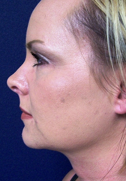 Vaser Liposelection Before & After