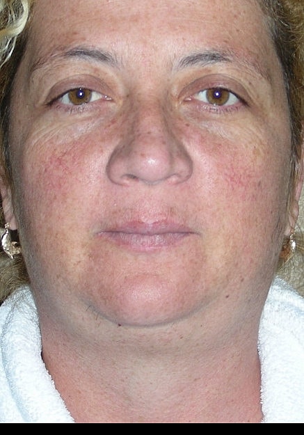 Vaser Liposelection Before & After