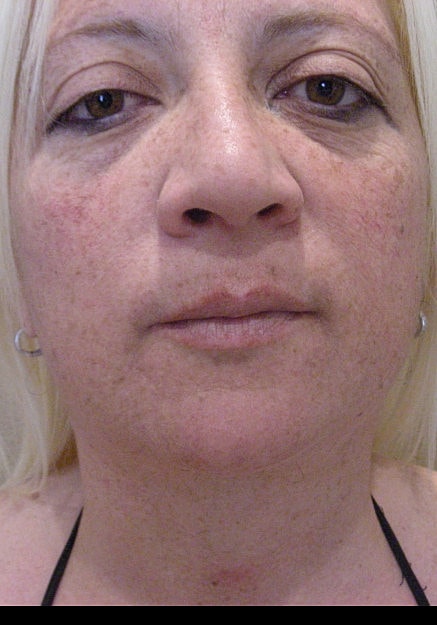 Vaser Liposelection Before & After