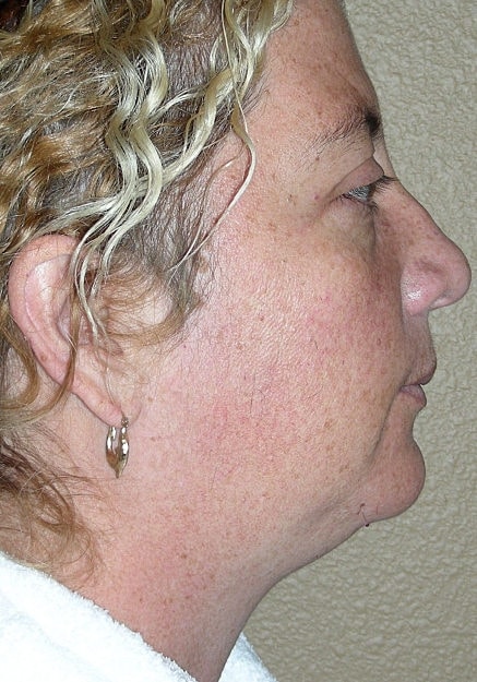 Vaser Liposelection Before & After