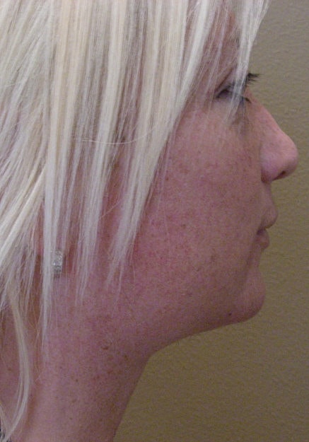Vaser Liposelection Before & After