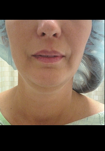 Vaser Liposelection Before & After