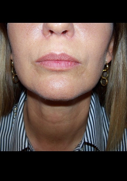 Vaser Liposelection Before & After