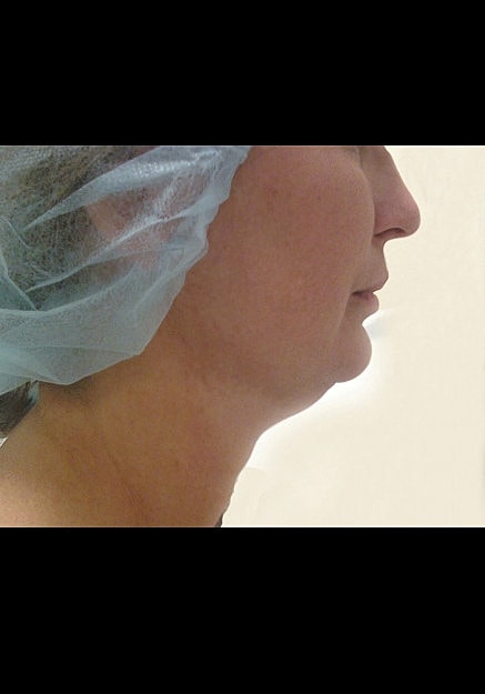 Vaser Liposelection Before & After