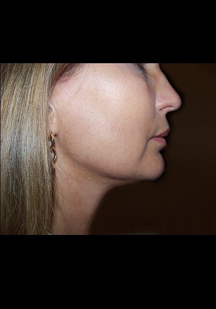 Vaser Liposelection Before & After