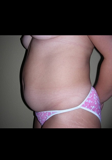 Vaser Liposelection Before & After