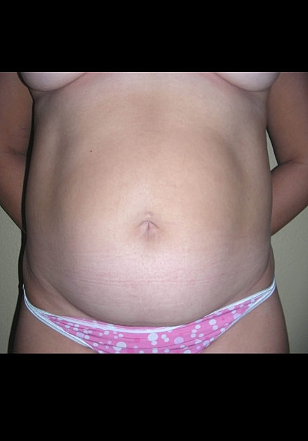 Vaser Liposelection Before & After