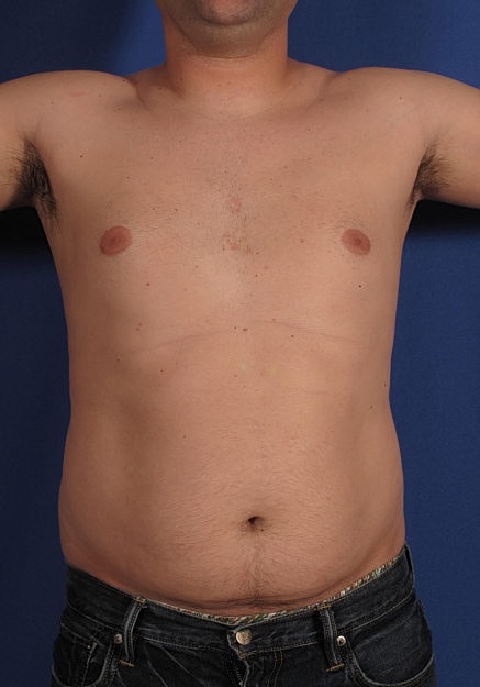 Vaser Liposelection Before & After