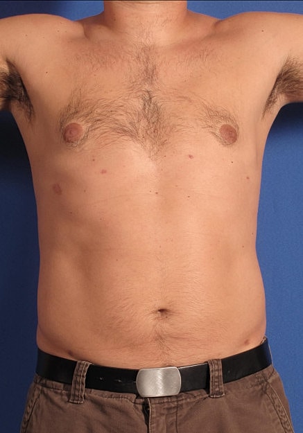 Vaser Liposelection Before & After