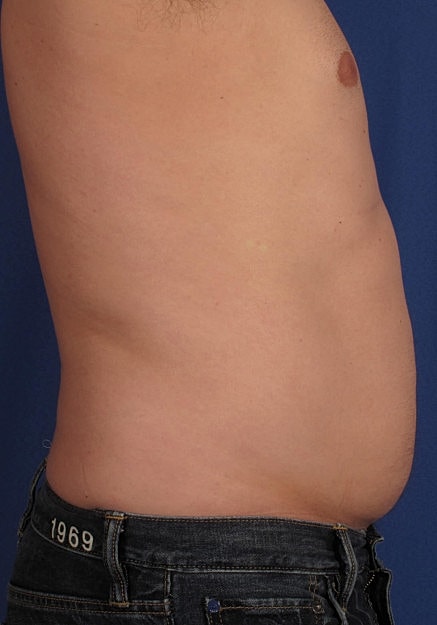 Vaser Liposelection Before & After