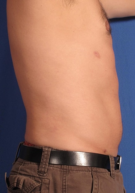 Vaser Liposelection Before & After
