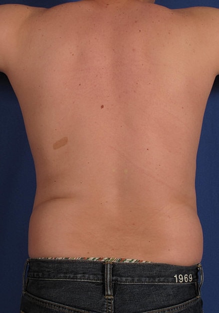 Vaser Liposelection Before & After