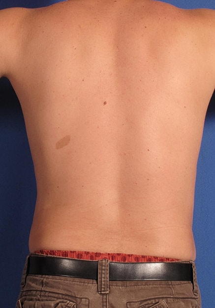 Vaser Liposelection Before & After