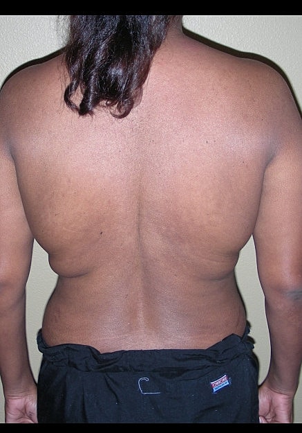 Vaser Liposelection Before & After