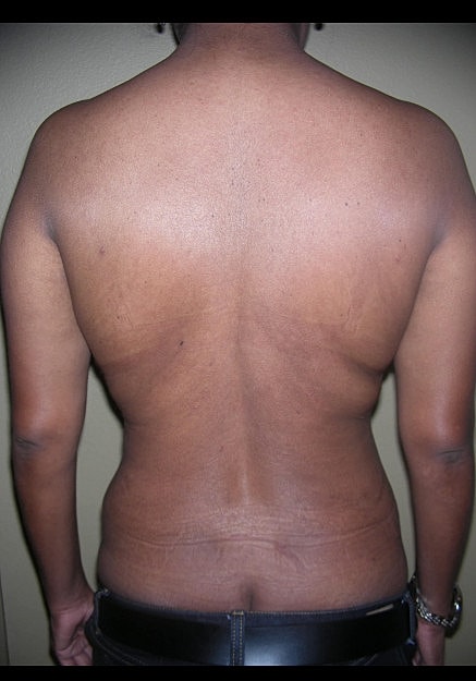 Vaser Liposelection Before & After
