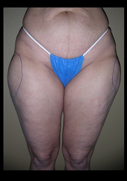 Vaser Liposelection Before & After