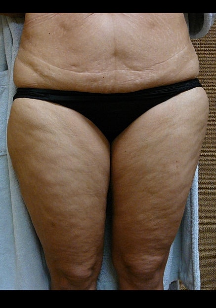 Vaser Liposelection Before & After