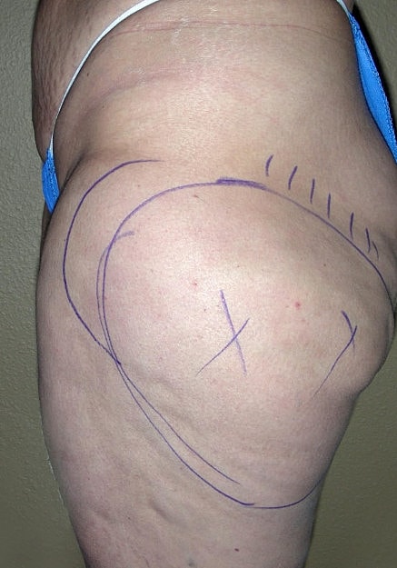 Vaser Liposelection Before & After