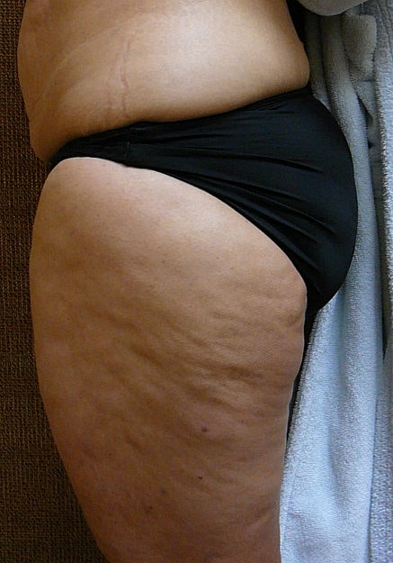 Vaser Liposelection Before & After