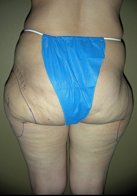 Vaser Liposelection Before & After