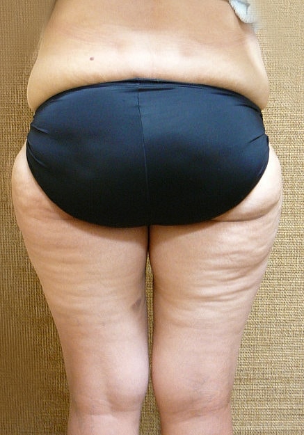 Vaser Liposelection Before & After