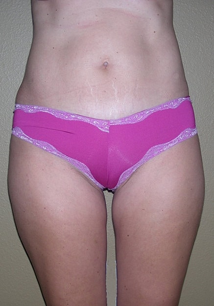 Vaser Liposelection Before & After