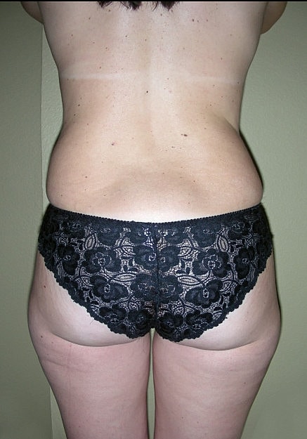Vaser Liposelection Before & After