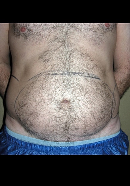 Vaser Liposelection Before & After