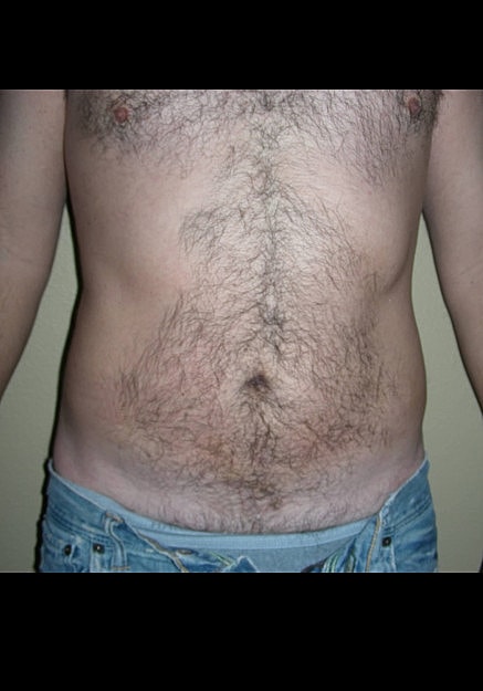 Vaser Liposelection Before & After