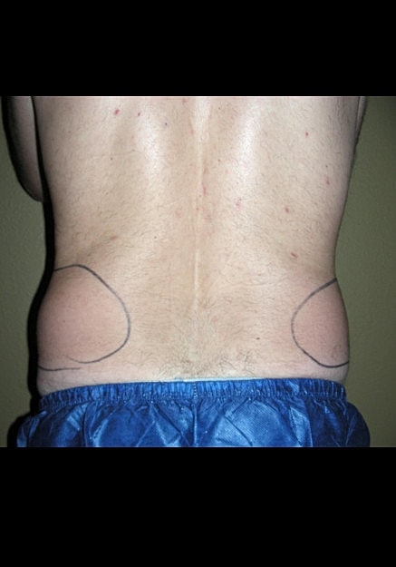 Vaser Liposelection Before & After