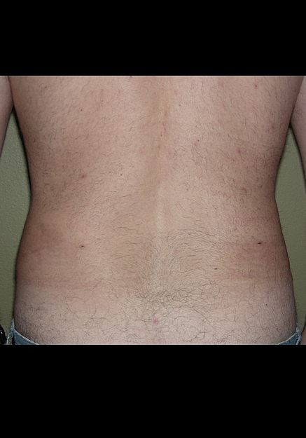 Vaser Liposelection Before & After