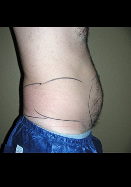 Vaser Liposelection Before & After