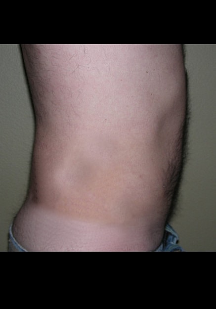 Vaser Liposelection Before & After
