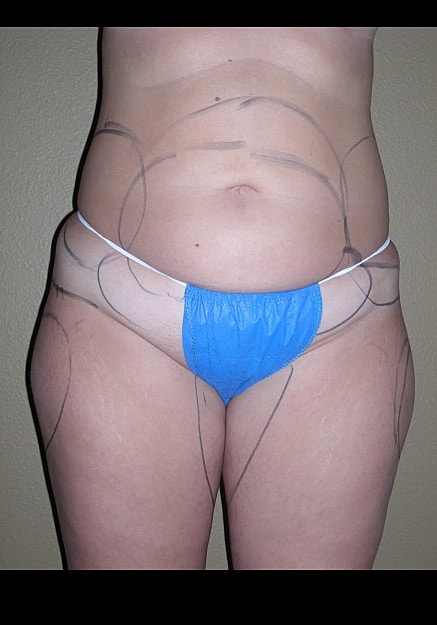 Vaser Liposelection Before & After