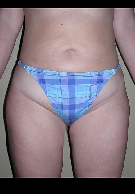 Vaser Liposelection Before & After