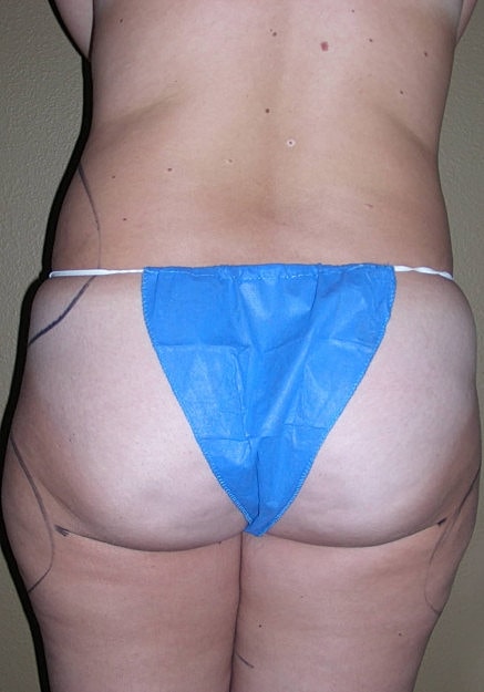 Vaser Liposelection Before & After