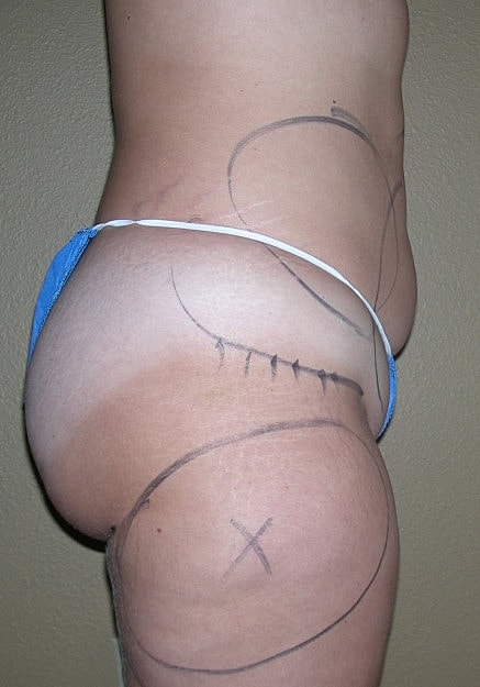 Vaser Liposelection Before & After