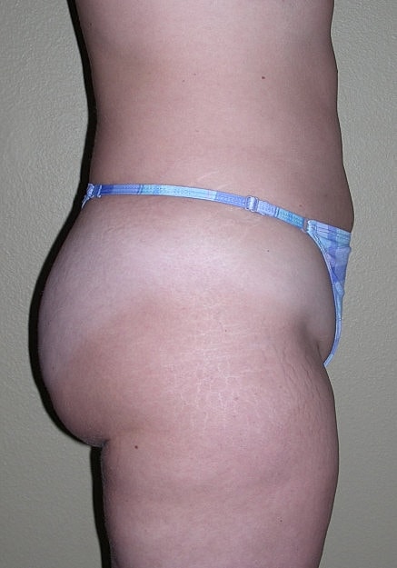 Vaser Liposelection Before & After