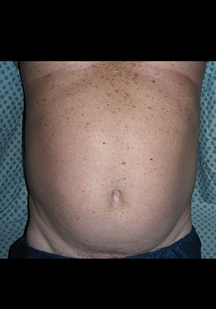 Vaser Liposelection Before & After