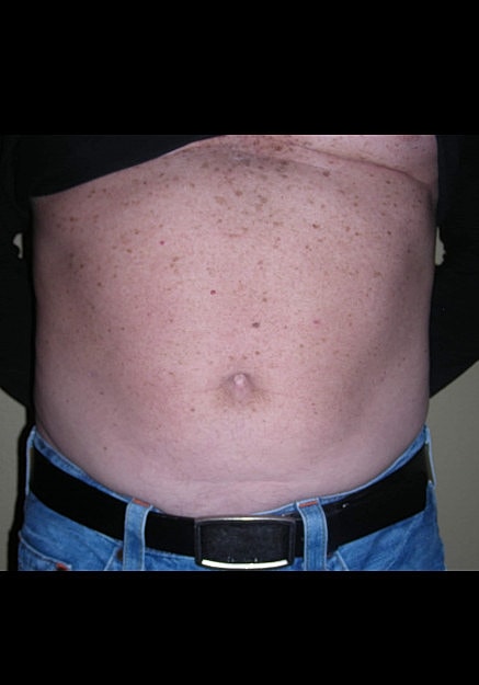 Vaser Liposelection Before & After