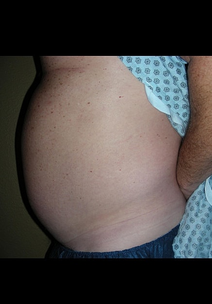 Vaser Liposelection Before & After