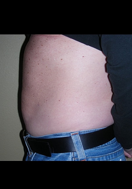 Vaser Liposelection Before & After