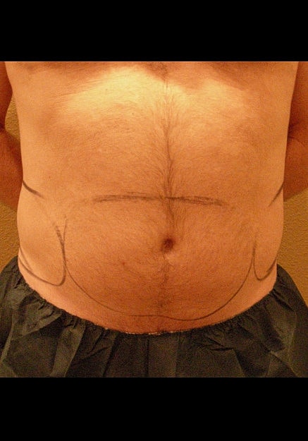 Vaser Liposelection Before & After