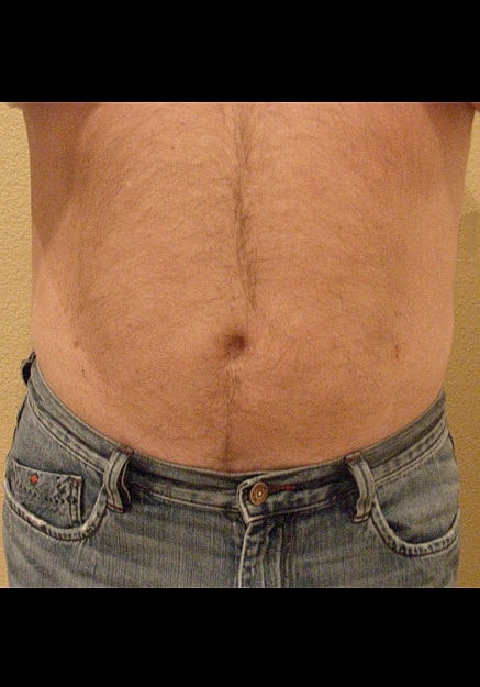 Vaser Liposelection Before & After