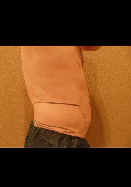 Vaser Liposelection Before & After