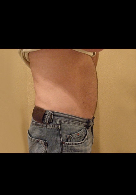 Vaser Liposelection Before & After