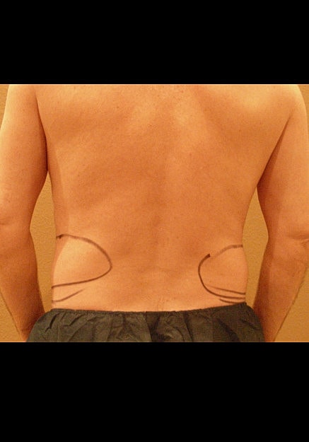 Vaser Liposelection Before & After