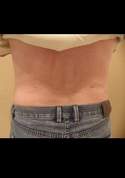 Vaser Liposelection Before & After