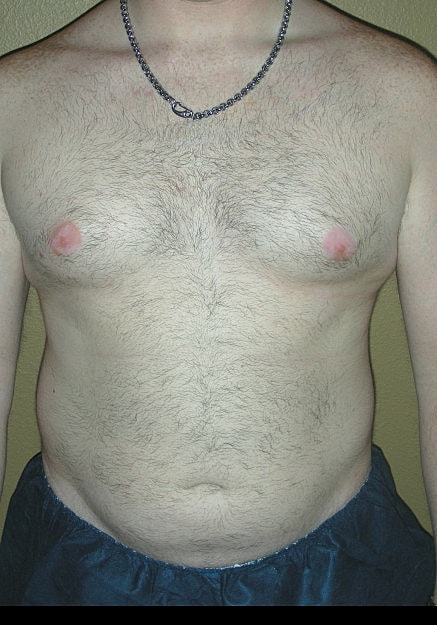 Vaser Liposelection Before & After